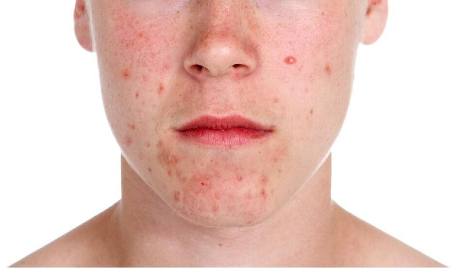 Psoriasis in the face