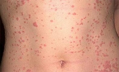 Psoriasis on the body