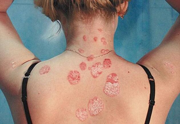 Psoriasis on the back