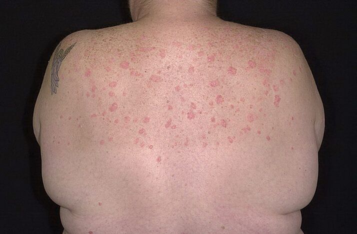 Psoriasis on the shoulder