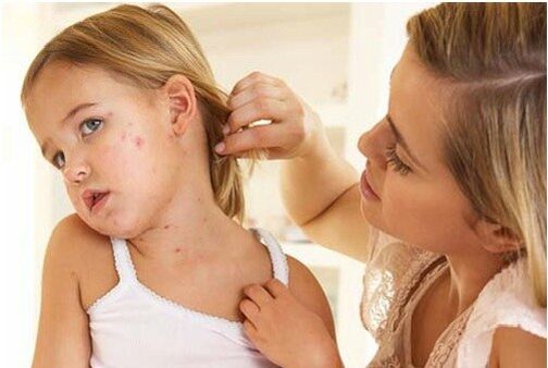 Early stage photo psoriasis