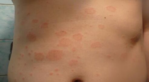 Early stage psoriasis