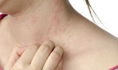 treatment of advanced stage psoriasis
