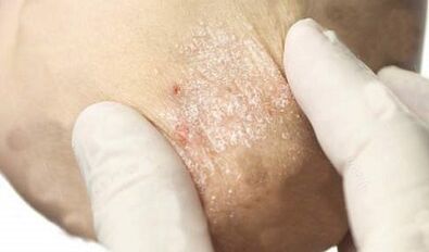 treatment of psoriasis in the minimization stage