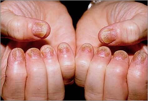 Nail psoriasis