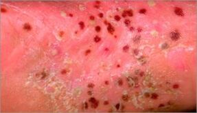 Pustular psoriasis