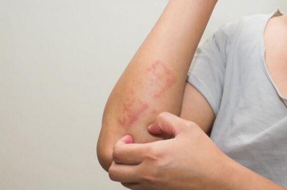 The latest methods for treating psoriasis
