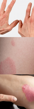 Early stage psoriasis in hand