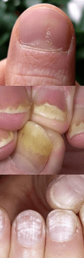 Nail psoriasis - early stage