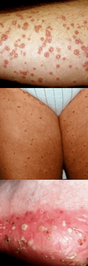 Psoriasis on the feet