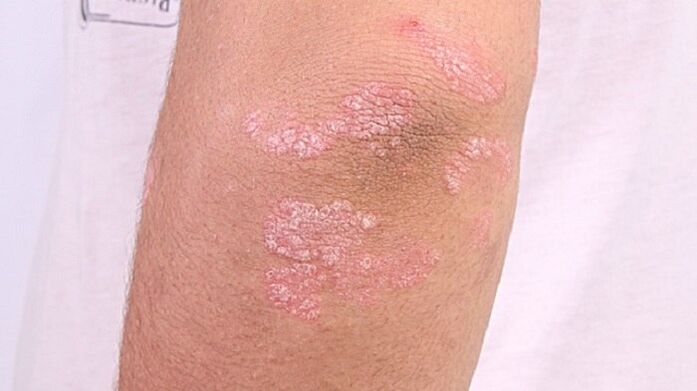 pictures of early stage psoriasis