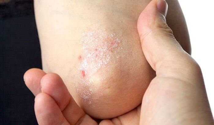 symptoms of psoriasis in the early stages