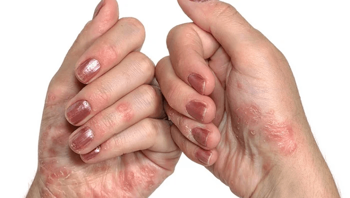 The early stages of psoriasis
