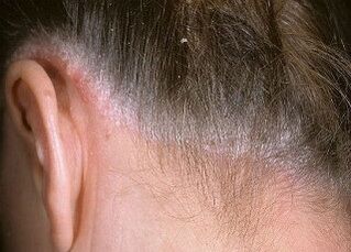causes of psoriasis in the scalp