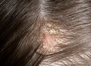 the main symptoms of psoriasis in the head