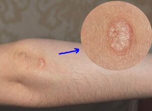 Why you need to know the stages of psoriasis