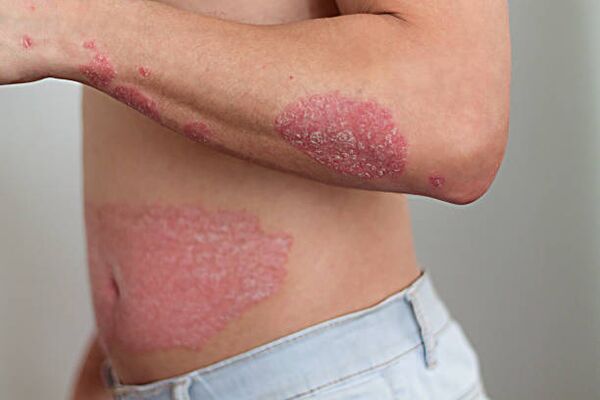 psoriasis on the male body