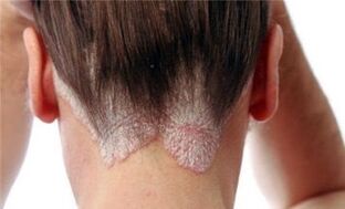 the form and stage of development of psoriasis