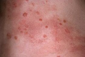 pictures of psoriasis on the skin