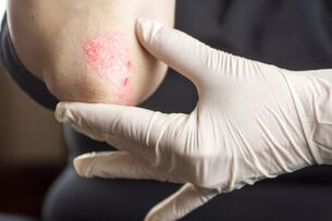 Principles of psoriasis treatment