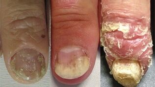 stage of development of nail psoriasis